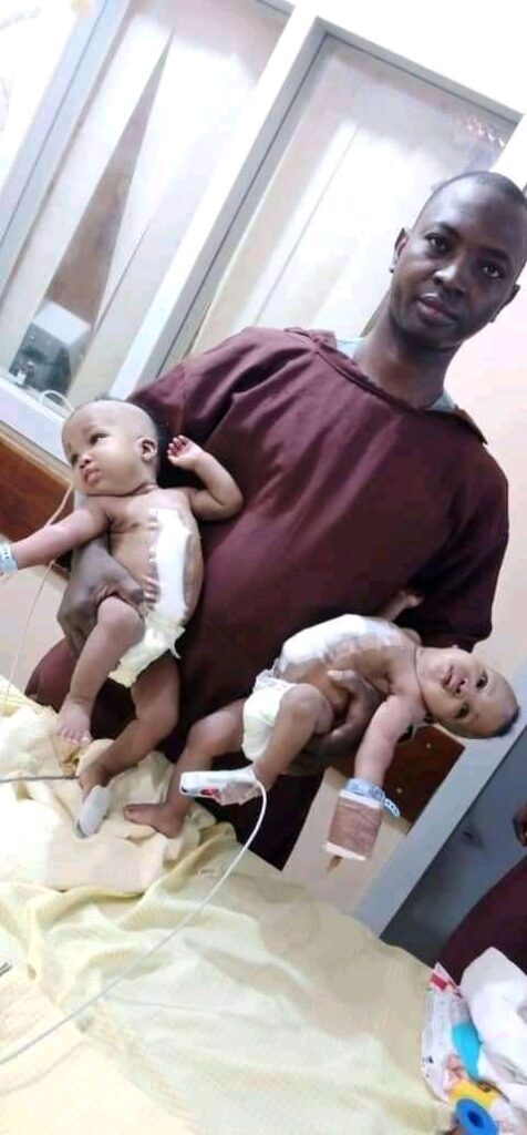 Ilorin Hospital Separated Conjoined Twins