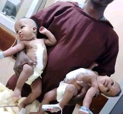 Ilorin Hospital Separated Conjoined Twins
