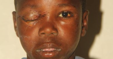 Almajiri boy whose eye was plucked in Bauchi