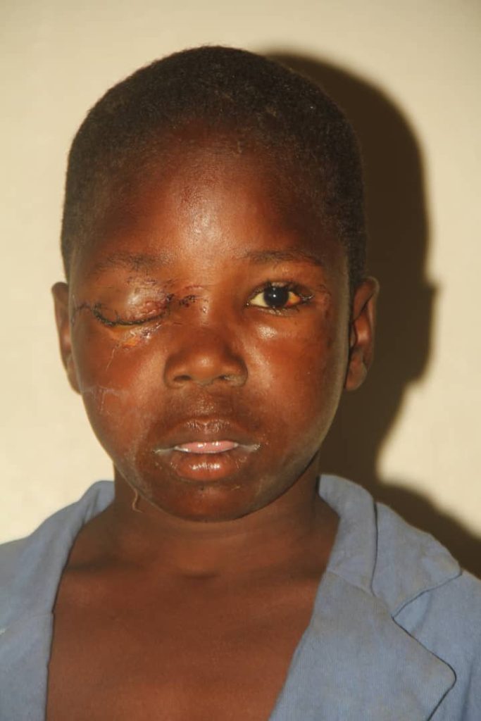 Almajiri boy whose eye was plucked in Bauchi