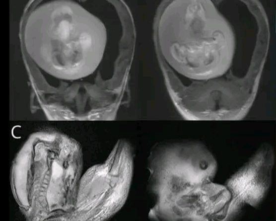 Miracle Surgery: Doctors Remove Four-Inch Foetus from Twin Sister's Skull