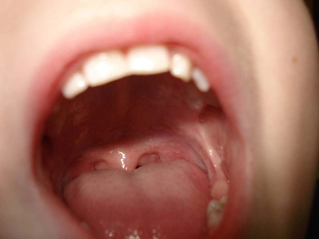 How to Prevent Cavities