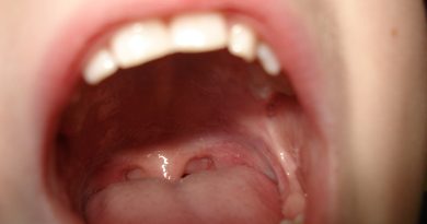 How to Prevent Cavities